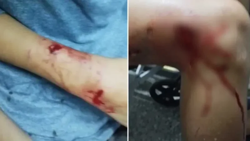 Menino de 12 anos leva sete pontos após ser atacado por pitbull enquanto brincava na rua: ‘Aflição foi grande’